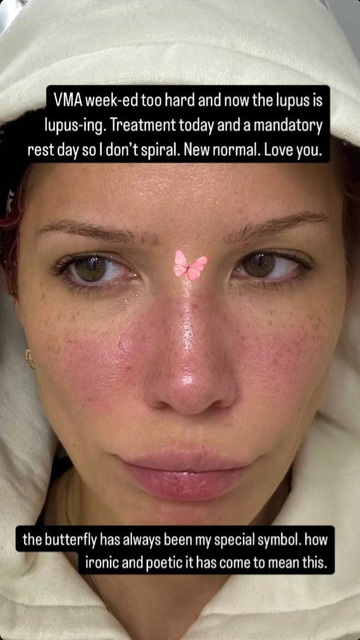 Captura stories Instagram. Primer plano de la cantante Halsey. Emoji mariposa rosa entre los ojos. Sobre las mejillas y la nariz el típico rash del Lupus en forma de mariposa. Mira hacia un lado. Capucha blanca. Texto: 'VMA week-ed too hard and now the lupus is lupus-ing. Treatment today and a mandatory rest day so I don't spiral. New normal. Love you.

the butterfly has always been my special symbol. how ironic and poetic it has come to mean this'.
